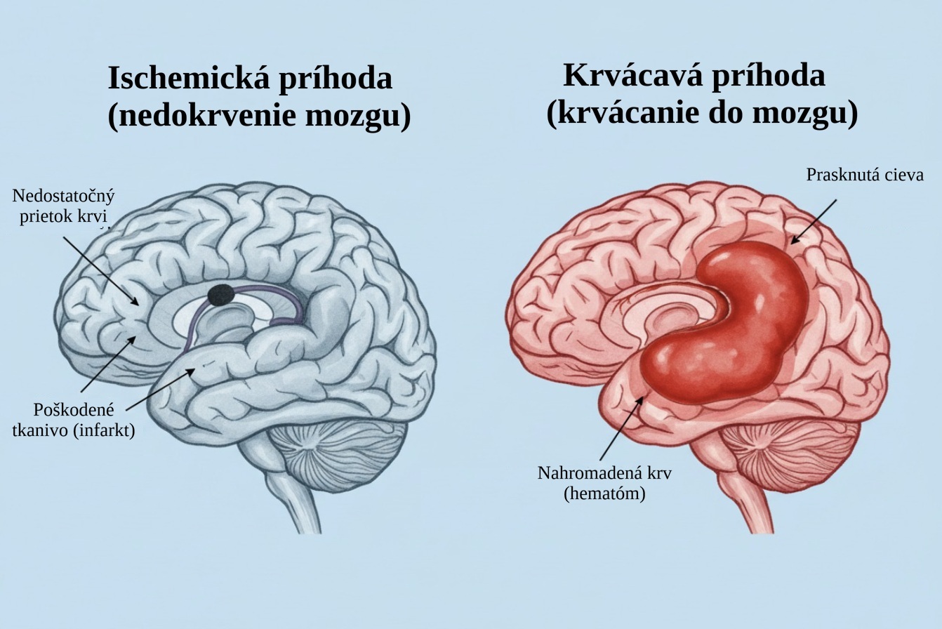 Dva obrázky mozgu. Jeden nedokrvenie mozgu pre uchatú cievu. Druhý s prasknutou cievou s krvácaním do mozgu.